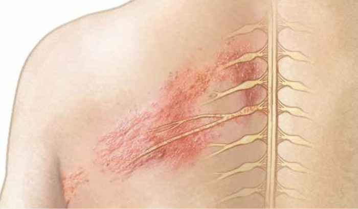 Bệnh zona thần kinh là gì? Nguyên nhân, triệu chứng và cách điều trị hiệu quả hình 1 benh-zona-than-kinh-la-gi-nguyen-nhan-trieu-chung-va-cach-dieu-tri-hieu-qua-hinh-1.jpg