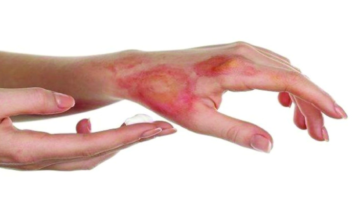 Bị phỏng nên làm gì ngay lập tức? Hướng dẫn sơ cứu đúng cách hình 2 bi-phong-nen-lam-gi-ngay-lap-tuc-huong-dan-so-cuu-dung-cach-hinh-2.jpg