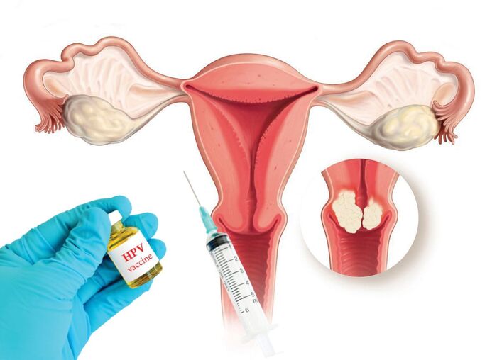 Biểu hiện ung thư cổ tử cung có dễ nhận biết không? hình 2 bieu-hien-ung-thu-co-tu-cung-co-de-nhan-biet-khong-hinh-2.jpg