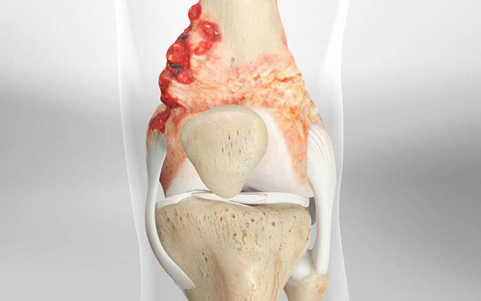 Dấu hiệu ung thư xương ở giai đoạn đầu: Nhận biết để điều trị kịp thời hình 2 dau-hieu-ung-thu-xuong-o-giai-doan-dau-nhan-biet-de-dieu-tri-kip-thoi-hinh-2.jpg