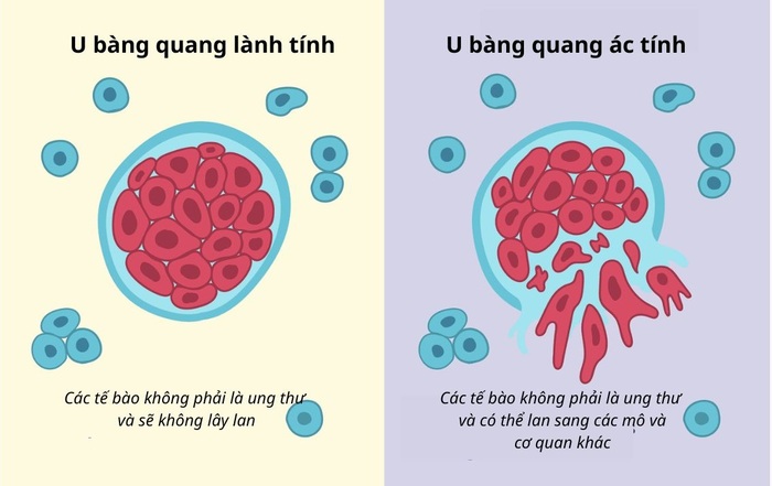 Ung thư bàng quang: Nguyên nhân, triệu chứng và cách điều trị hiệu quả hình 3 ung-thu-bang-quang-nguyen-nhan-trieu-chung-va-cach-dieu-tri-hieu-qua-hinh-3.jpg