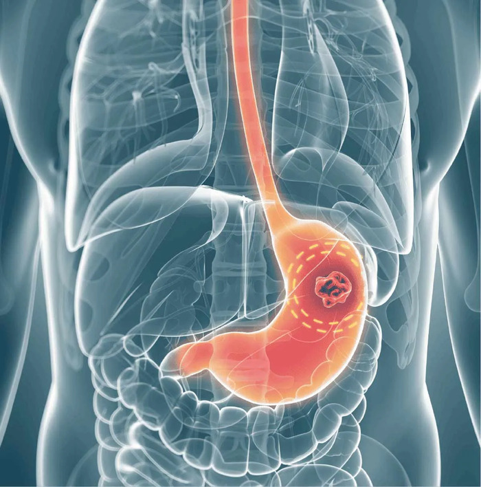 Ung thư dạ dày: Nguyên nhân, triệu chứng và cách điều trị hiệu quả hình 4 ung-thu-da-day-nguyen-nhan-trieu-chung-va-cach-dieu-tri-hieu-qua-hinh-4.jpg