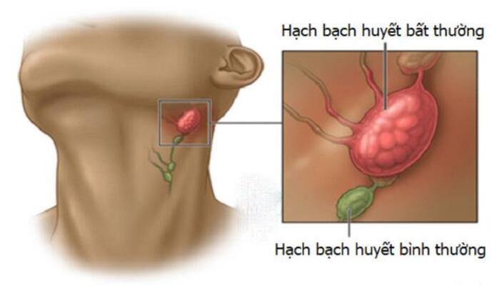Ung thư hạch bạch huyết: Dấu hiệu, nguyên nhân và cách phòng ngừa số 1 ung-thu-hach-bach-huyet-dau-hieu-nguyen-nhan-va-cach-phong-ngua-so-1.jpg