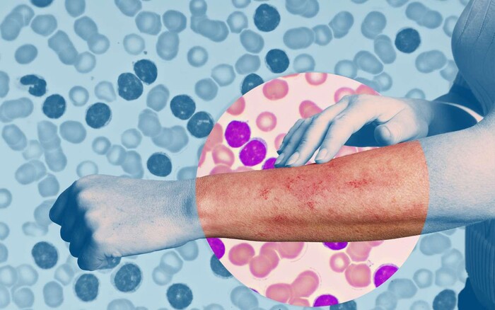 Ung thư máu là gì? Nguyên nhân, triệu chứng và phương pháp điều trị hình 3 ung-thu-mau-la-gi-nguyen-nhan-trieu-chung-va-phuong-phap-dieu-tri-hinh-3.jpg