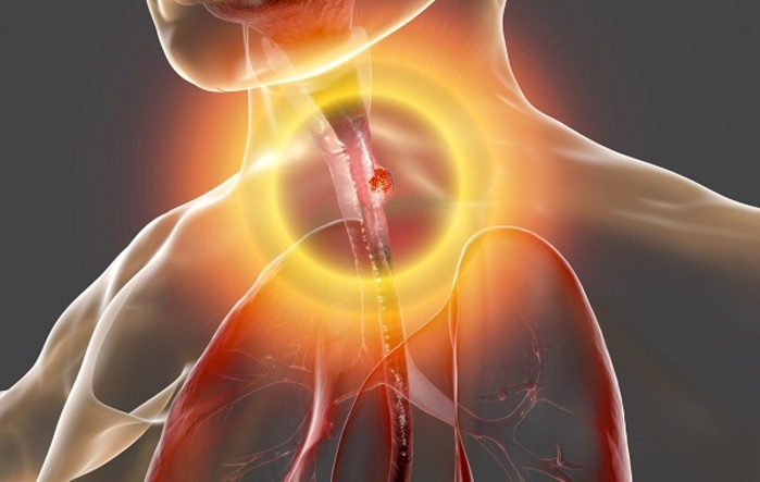 Ung thư thực quản: Nguyên nhân, triệu chứng và cách điều trị bệnh số 1 ung-thu-thuc-quan-nguyen-nhan-trieu-chung-va-cach-dieu-tri-benh-so-1.jpg