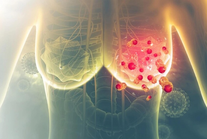 Ung thư vú có chữa được không? Sự thật mà bạn cần biết hình 1 ung-thu-vu-co-chua-duoc-khong-su-that-ma-ban-can-biet-hinh-1.jpg