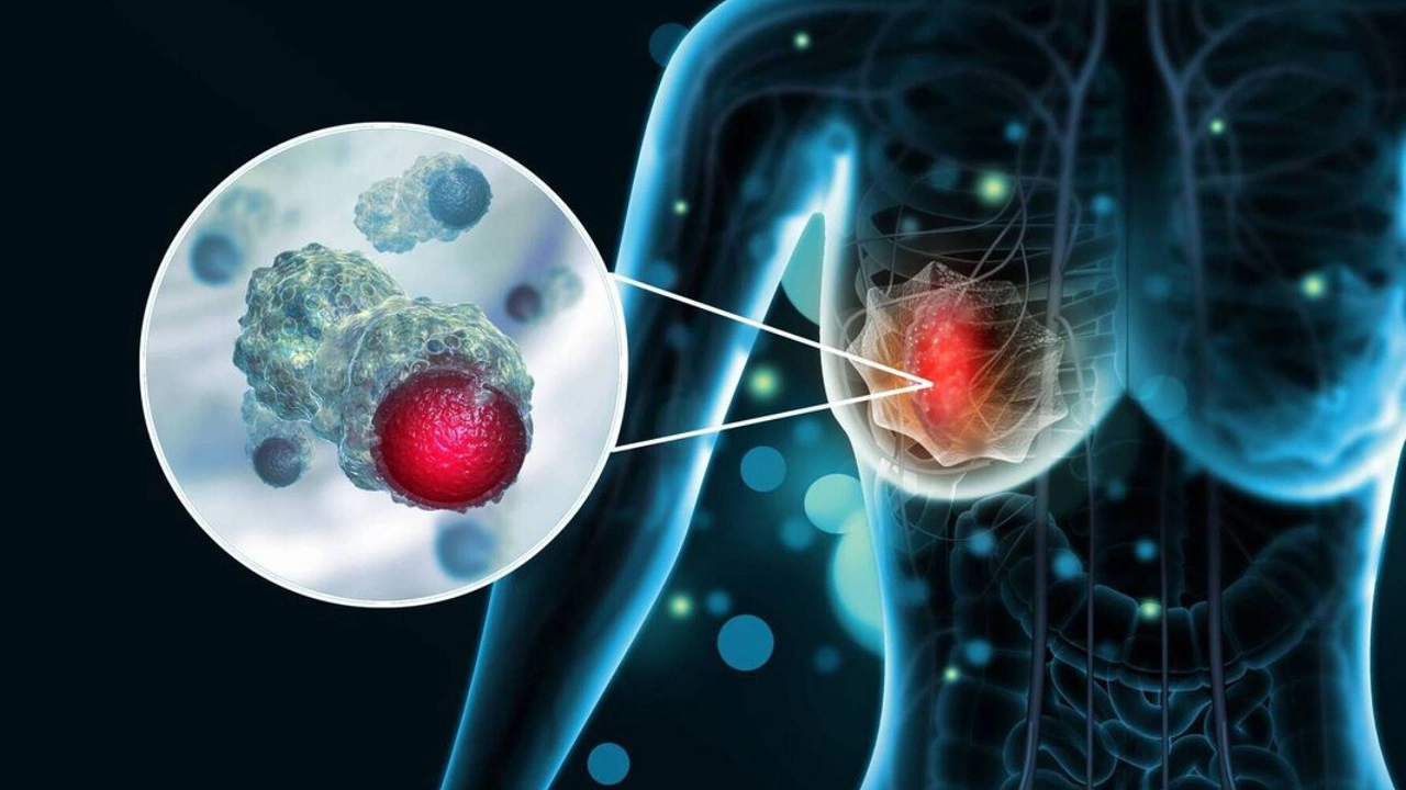 Ung thư vú có chữa được không? Sự thật mà bạn cần biết