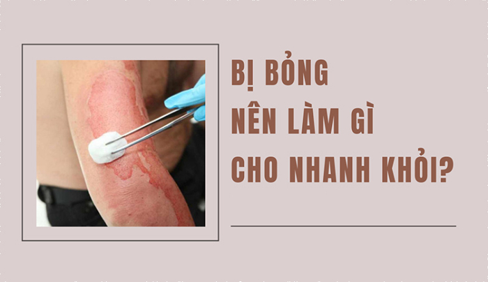 Bị bỏng nên làm gì? Top 8 cách trị bỏng hiệu quả tại nhà hình 1 bi-bong-nen-lam-gi-top-8-cach-tri-bong-hieu-qua-tai-nha-hinh-1.jpg