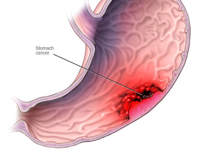 Các dấu hiệu ung thư dạ dày cần đi thăm khám ngay hình 1 cac-dau-hieu-ung-thu-da-day-can-di-tham-kham-ngay-hinh-1.jpg