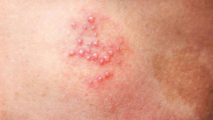 Giải đáp: Có thể trị zona thần kinh tận gốc mà không cần dùng thuốc? hình 1 giai-dap-co-the-tri-zona-than-kinh-tan-goc-ma-khong-can-dung-thuoc-hinh-1.jpg