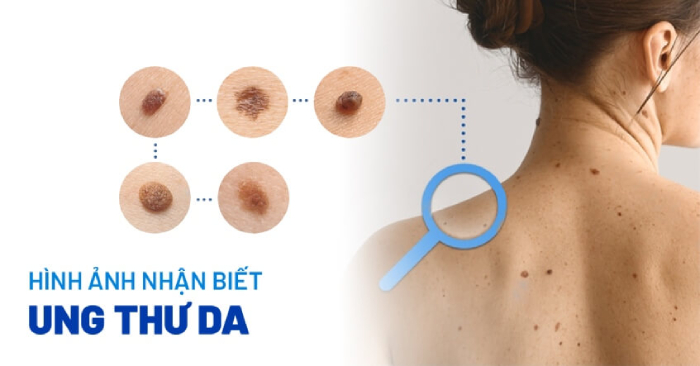 Một số hình ảnh ung thư da dễ nhận biết và không nên chủ quan hình 1 mot-so-hinh-anh-ung-thu-da-de-nhan-biet-va-khong-nen-chu-quan-hinh-1.jpg