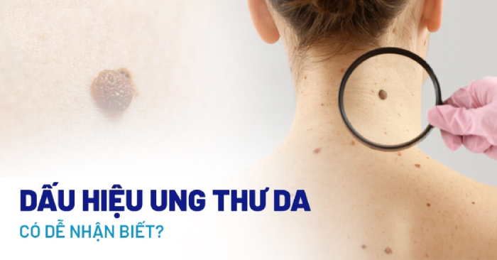 Một số hình ảnh ung thư da dễ nhận biết và không nên chủ quan hình 2 mot-so-hinh-anh-ung-thu-da-de-nhan-biet-va-khong-nen-chu-quan-hinh-2.jpg