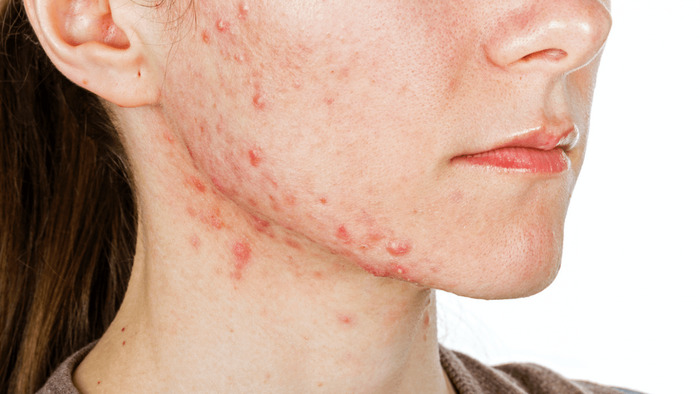 Mụn nội tiết do rối loạn hormone: Nguyên nhân và cách cân bằng hình 1 mun-noi-tiet-do-roi-loan-hormone-nguyen-nhan-va-cach-can-bang-hinh-1.jpg