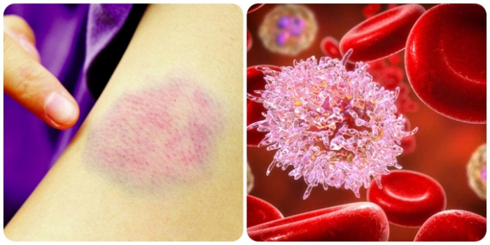 Tìm hiểu bệnh ung thư máu có chữa được không? hình 1 tim-hieu-benh-ung-thu-mau-co-chua-duoc-khong-hinh-1.jpg