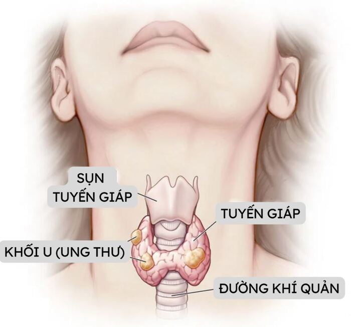 Tìm hiểu những dấu hiệu ung thư tuyến giáp hình 2 tim-hieu-nhung-dau-hieu-ung-thu-tuyen-giap-hinh-2.jpg