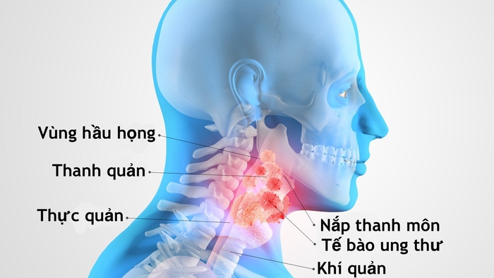Ung thư thanh quản có nguy hiểm không? Những điều bạn cần biết hình 2 ung-thu-thanh-quan-co-nguy-hiem-khong-nhung-dieu-ban-can-biet-hinh-2.jpg