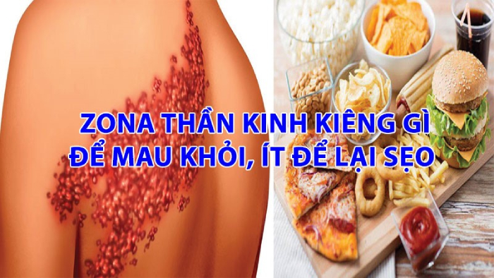 Zona thần kinh kiêng gì để mau khỏi bệnh? hình 2 zona-than-kinh-kieng-gi-de-mau-khoi-benh-hinh-2.jpg