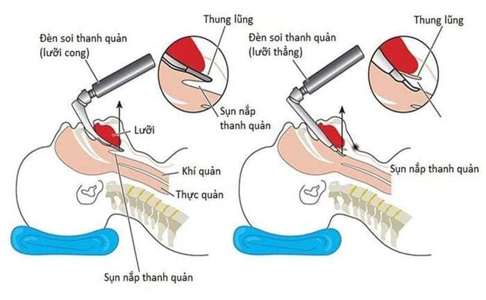 Cách cố định ống nội khí quản: Quy trình, kỹ thuật và lưu ý lâm sàng hình 4 cach-co-dinh-ong-noi-khi-quan-quy-trinh-ky-thuat-va-luu-y-lam-sang-hinh-4.jpg