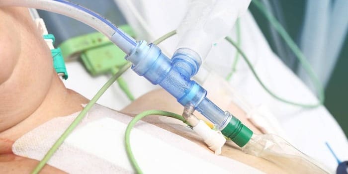 Tìm hiểu quy trình chuẩn khi đặt ống nội khí quản qua đường miệng hình 2 tim-hieu-quy-trinh-chuan-khi-dat-ong-noi-khi-quan-qua-duong-mieng-hinh-2.jpg