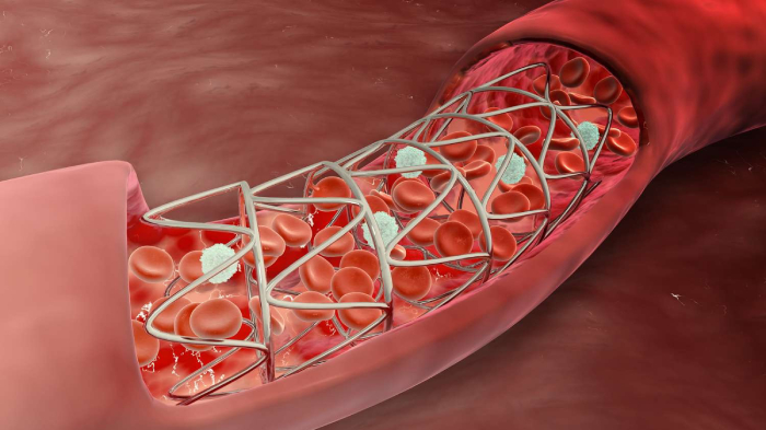 Chỉ định đặt máy stent tim và quy trình thực hiện hình 2 chi-dinh-dat-may-stent-tim-va-quy-trinh-thuc-hien-hinh-2.jpg