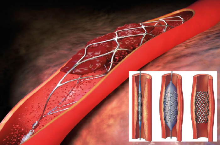 Chỉ định đặt máy stent tim và quy trình thực hiện hình 3 chi-dinh-dat-may-stent-tim-va-quy-trinh-thuc-hien-hinh-3.jpg