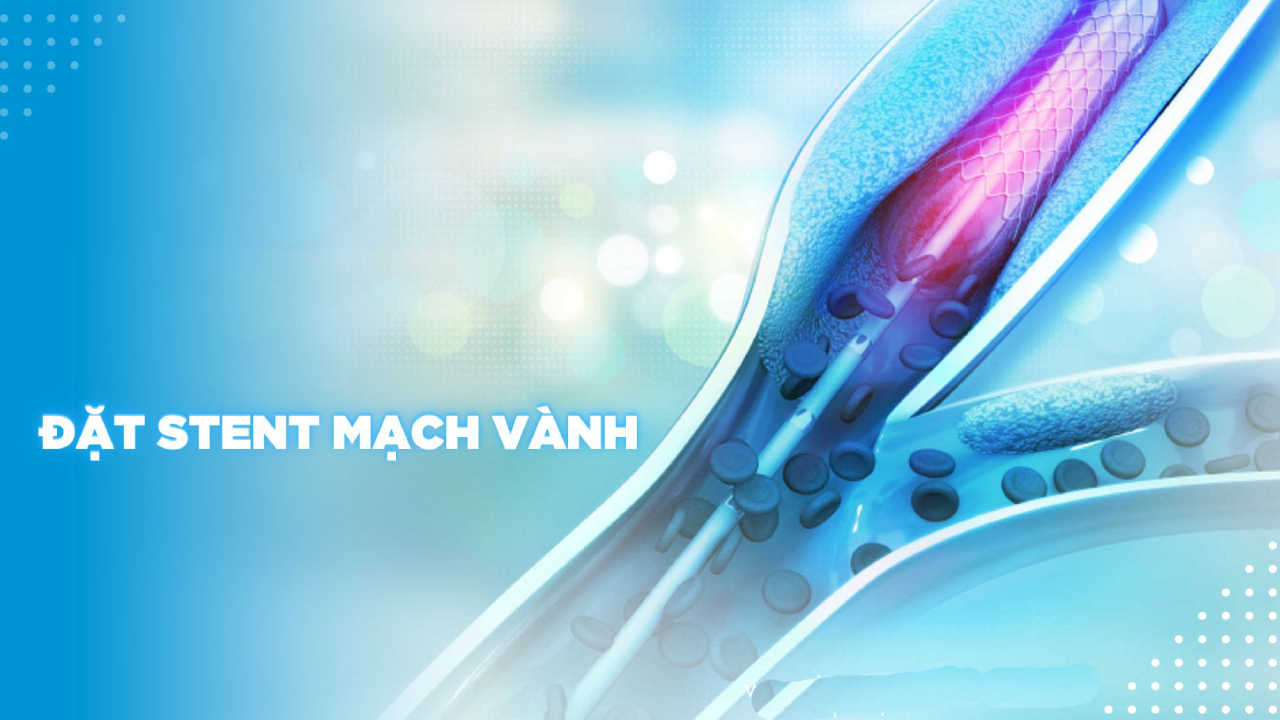 Chỉ định đặt máy stent tim và quy trình thực hiện