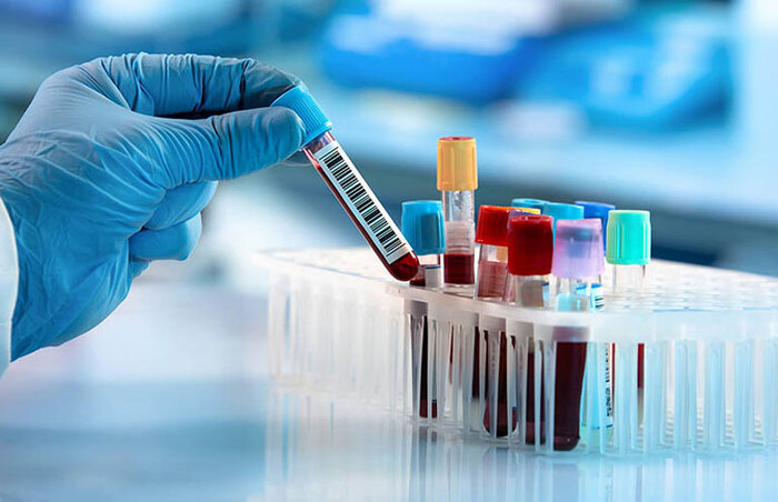 Chỉ số GGT là gì và có liên quan thế nào đến bệnh gan? hình 4 chi-so-ggt-la-gi-va-co-lien-quan-the-nao-den-benh-gan-hinh-4.jpg