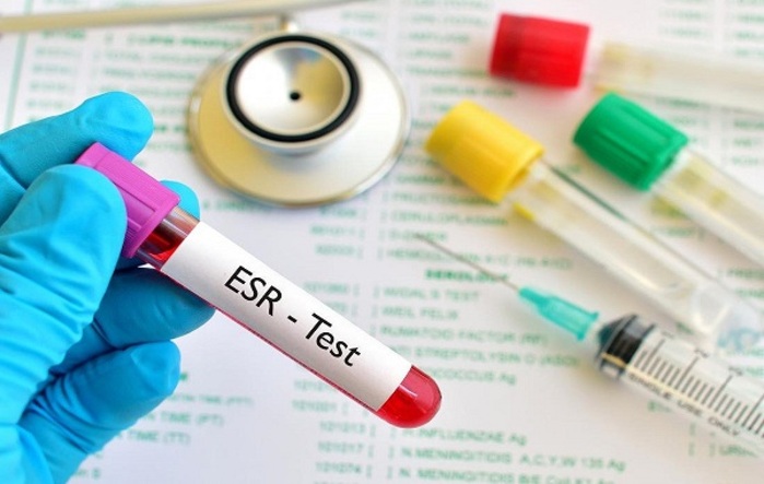 Giải đáp thắc mắc: Xét nghiệm máu lắng để làm gì? số 5 giai-dap-thac-mac-xet-nghiem-mau-lang-de-lam-gi-so-5.jpg