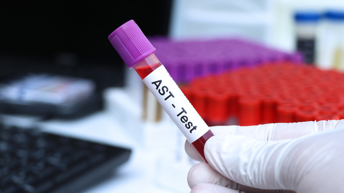 Giải mã AST trong xét nghiệm máu là gì: Vai trò và ý nghĩa lâm sàng hình 1 giai-ma-ast-trong-xet-nghiem-mau-la-gi-vai-tro-va-y-nghia-lam-sang-hinh-1.jpg
