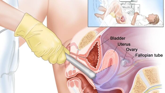 Giải mã lo lắng cho mẹ bầu: Siêu âm đầu dò có gây sảy thai không? hình 1 giai-ma-lo-lang-cho-me-bau-sieu-am-dau-do-co-gay-say-thai-khong-hinh-1.jpg