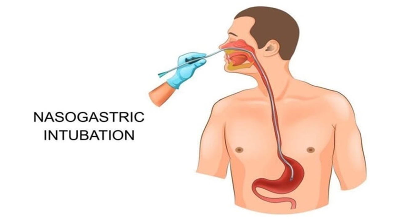 Kỹ thuật đặt sonde dạ dày: Quy trình thực hiện và những điều cần lưu ý
