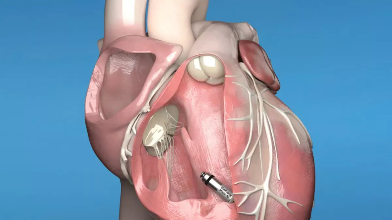 Một số chỉ định đặt máy tạo nhịp tạm thời