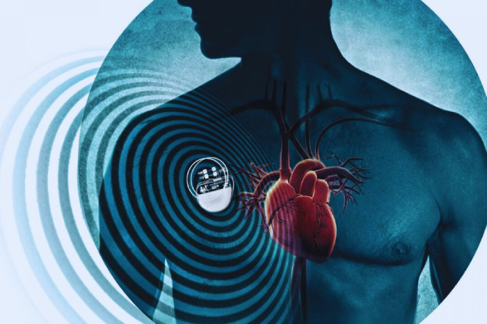 Một số trường hợp chỉ định đặt máy trợ tim hình 2 mot-so-truong-hop-chi-dinh-dat-may-tro-tim-hinh-2.jpg