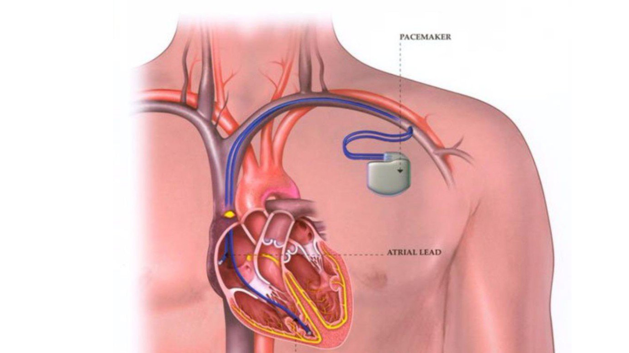 Một số trường hợp chỉ định đặt máy trợ tim