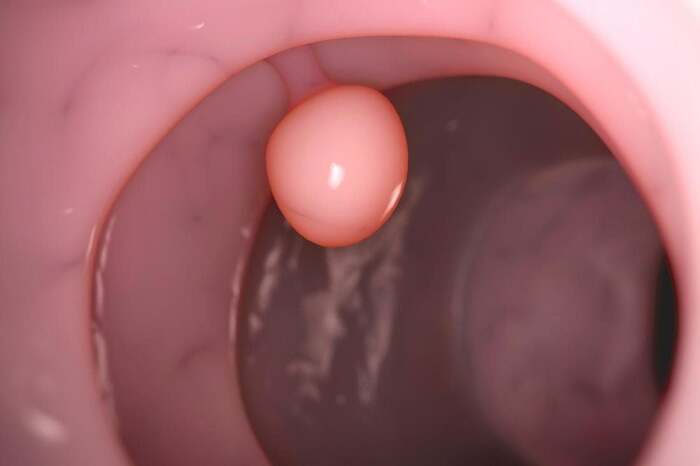 Polyp là gì và có nguy hiểm không? Siêu âm có phát hiện polyp không? hình 3 polyp-la-gi-va-co-nguy-hiem-khong-sieu-am-co-phat-hien-polyp-khong-hinh-3.jpg