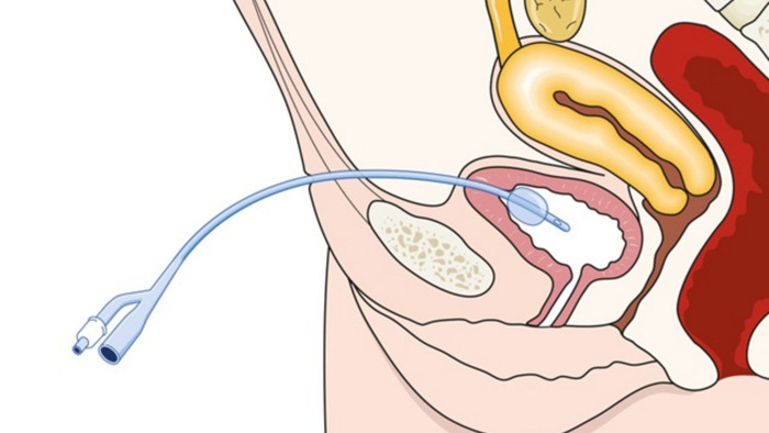 Quy trình đặt ống thông tiểu: Khi nào cần và ai nên thực hiện? hình 2 quy-trinh-dat-ong-thong-tieu-khi-nao-can-va-ai-nen-thuc-hien-hinh-2.jpg