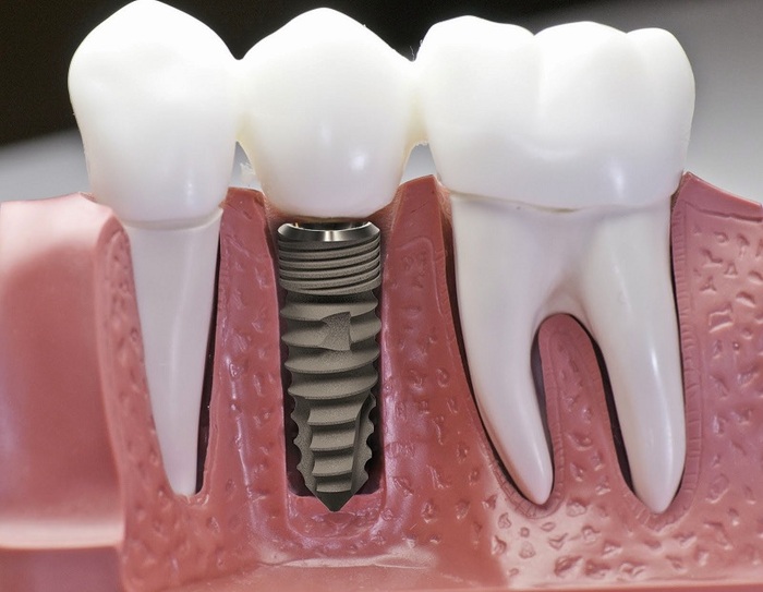 Quy trình kỹ thuật trồng răng Implant: Khái niệm, quy trình và lưu ý quan trọng hình 1 quy-trinh-ky-thuat-trong-rang-implant-khai-niem-quy-trinh-va-luu-y-quan-trong-hinh-1.jpg
