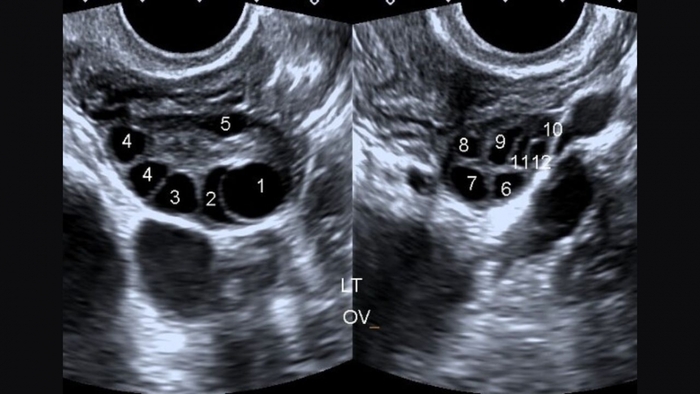 Tầm quan trọng của siêu âm buồng trứng đa nang trong chẩn đoán hiếm muộn hình 2 tam-quan-trong-cua-sieu-am-buong-trung-da-nang-trong-chan-doan-hiem-muon-hinh-2.jpg