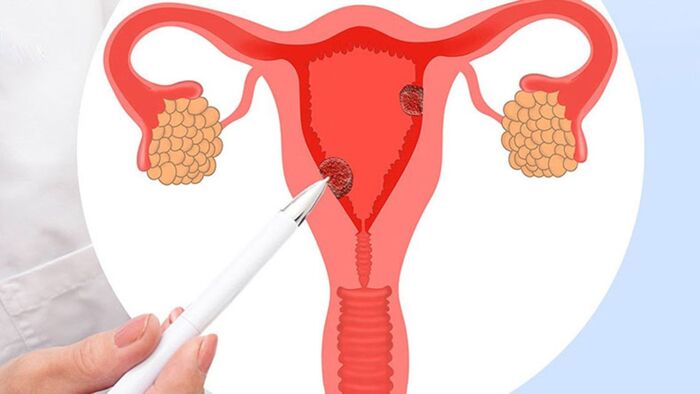 Tầm quan trọng của siêu âm buồng trứng đa nang trong chẩn đoán hiếm muộn hình 3 tam-quan-trong-cua-sieu-am-buong-trung-da-nang-trong-chan-doan-hiem-muon-hinh-3.jpg