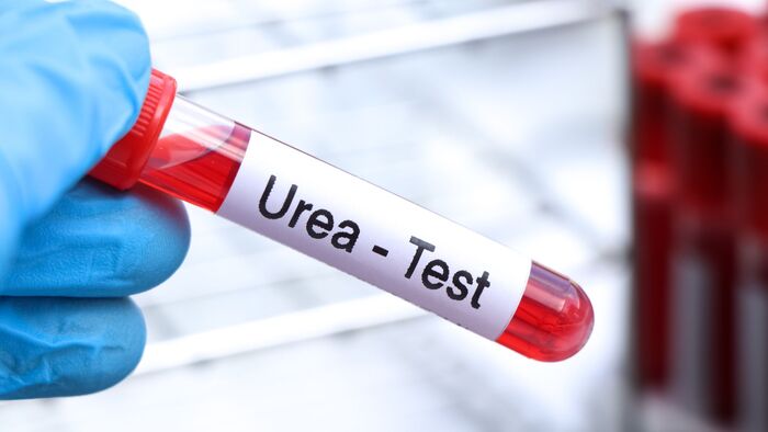 Ure là gì? Vai trò của phương pháp xét nghiệm ure máu hình 3 ure-la-gi-vai-tro-cua-phuong-phap-xet-nghiem-ure-mau-hinh-3.jpg